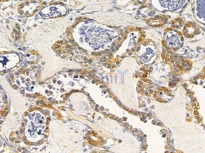 NCS1 Antibody - DF12665 at 1/100 staining human ovarian cancer by IHC-P.