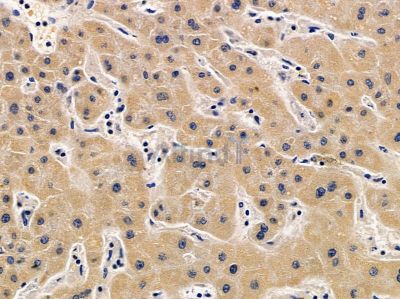 PTPRS Antibody - DF12714 at 1/100 staining human prostate cancer and para-carcinoma tissue by IHC-P.