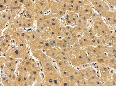 ARD1A Antibody - DF12828 at 1/100 staining human liver cancer by IHC-P.
