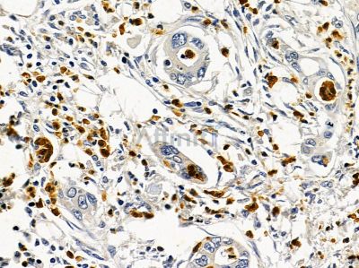 ARIH2 Antibody - DF12832 at 1/100 staining human pancreatic cancer and para-carcinoma tissue by IHC-P.