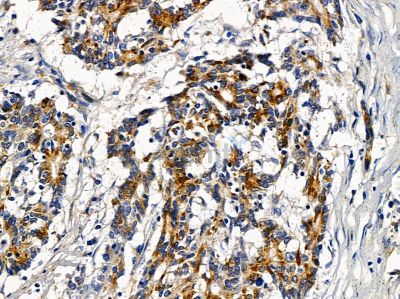 C4BPA Antibody - DF12869 at 1/100 staining human colorectal cancer by IHC-P.