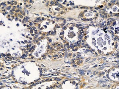 C5orf4 Antibody - DF12870 at 1/100 staining human ovarian cancer by IHC-P.