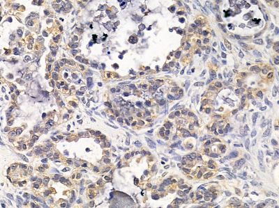 DIO2 Antibody - DF12941 at 1/100 staining human ovarian cancer by IHC-P.