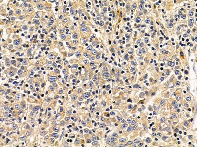 DNAJC21 Antibody - DF12950 at 1/100 staining human gastric cancer by IHC-P.