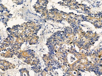 EXOC6 Antibody - DF12989 at 1/100 staining human colorectal cancer by IHC-P.