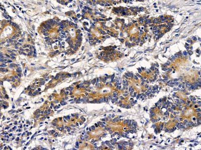 IFRD1 Antibody - DF2392 at 1/100 staining human colorectal cancer by IHC-P.
