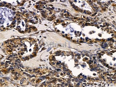 SRY Antibody - DF3242 at 1/100 staining human ovarian cancer by IHC-P.