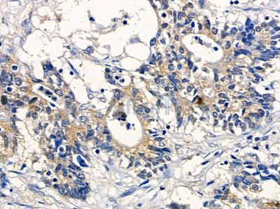 CNKSR1 Antibody - DF3389 at 1/100 staining human colorectal cancer and para-carcinoma tissue by IHC-P.