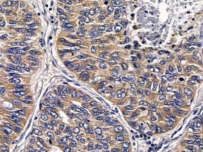 ABHD11 Antibody - DF3716 at 1/100 staining human lung cancer and para-carcinoma tissue by IHC-P.