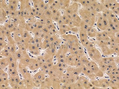 CXADR Antibody - DF3973 at 1/100 staining human liver cancer by IHC-P.