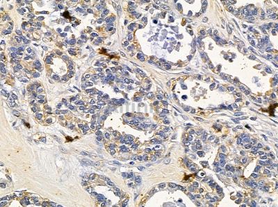 GFM2 Antibody - DF4035 at 1/100 staining human ovarian cancer by IHC-P.