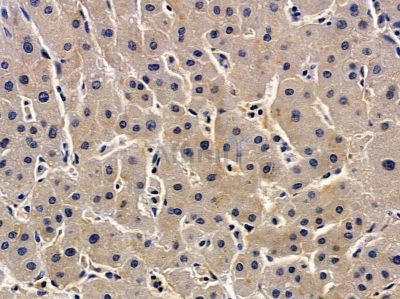 ZDHHC7 Antibody - DF4276 at 1/100 staining human prostate cancer and para-carcinoma tissue by IHC-P.