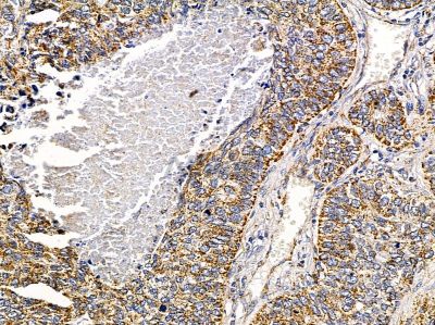 PHACTR4 Antibody - DF4289 at 1/100 staining human lung cancer and para-carcinoma tissue by IHC-P.