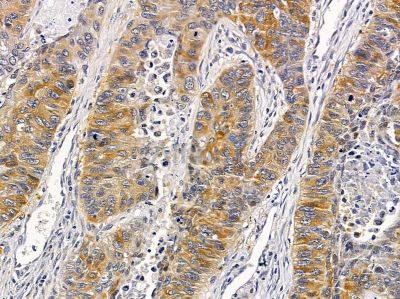 ZDHHC20 Antibody - DF4335 at 1/100 staining human lung cancer and para-carcinoma tissue by IHC-P.