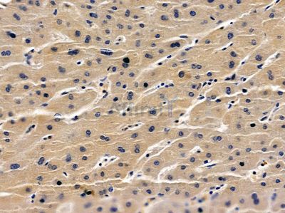 HBAP1 Antibody - DF4703 at 1/100 staining human liver cancer by IHC-P.