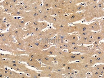 SNIP Antibody - DF4723 at 1/100 staining human liver cancer by IHC-P.