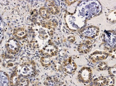 ERI1 Antibody - DF4800 at 1/100 staining human ovarian cancer by IHC-P.