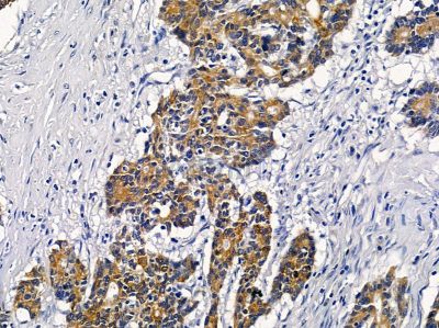 VN1R2 Antibody - DF5174 at 1/100 staining human colorectal cancer by IHC-P.