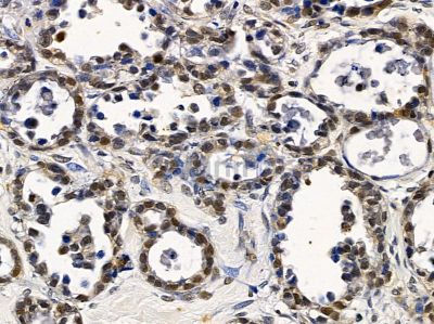 CRY1 Antibody - DF8932 at 1/100 staining human ovarian cancer by IHC-P.
