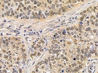 CRY1 Antibody - DF8932 at 1/100 staining human lung cancer and para-carcinoma tissue by IHC-P.