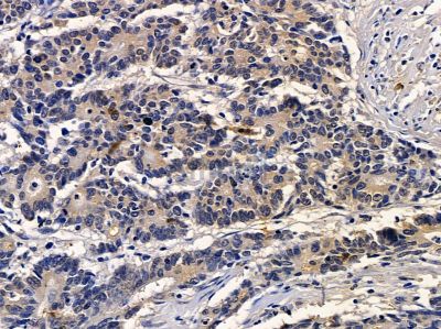 TRIM23 Antibody - DF9551 at 1/100 staining human colorectal cancer by IHC-P.