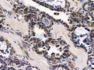 RAB17 Antibody - DF9815 at 1/100 staining human ovarian cancer by IHC-P.