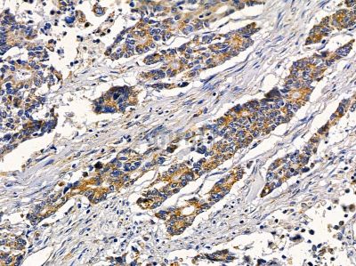 RAB21 Antibody - DF9819 at 1/100 staining human colorectal cancer by IHC-P.
