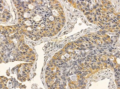 Aurora A Mouse Monoclonal Antibody - BF8273 at 1/100 staining human lung cancer and para-carcinoma tissue by IHC-P.