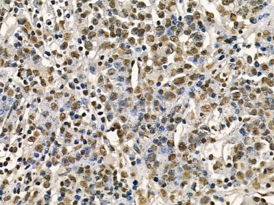 MKK3/MKK6 Mouse Monoclonal Antibody - BF8429 at 1/100 staining human esophageal cancer and para-carcinoma tissue by IHC-P.
