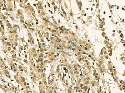 Hsp90 alpha Mouse Monoclonal Antibody - BF8449 at 1/100 staining human gastric cancer by IHC-P.