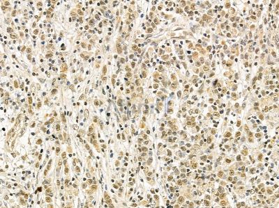 DDX39 Mouse Monoclonal Antibody - BF8487 at 1/100 staining human gastric cancer by IHC-P.