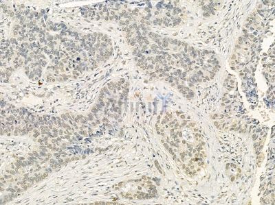 DDX39 Mouse Monoclonal Antibody - BF8487 at 1/100 staining human lung cancer and para-carcinoma tissue by IHC-P.