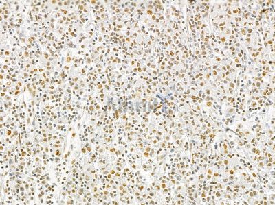 Ku70/80 Mouse Monoclonal Antibody - BF8506 at 1/100 staining human gastric cancer by IHC-P.