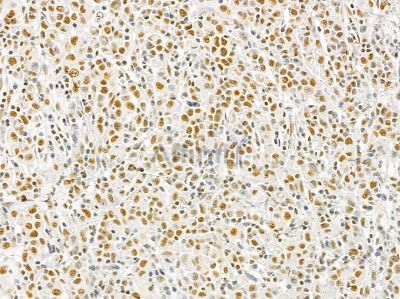 Ku70/80 Mouse Monoclonal Antibody - BF8506 at 1/100 staining human gastric cancer by IHC-P.