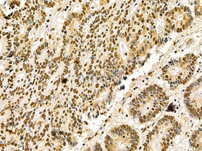 Ku70/80 Mouse Monoclonal Antibody - BF8506 at 1/100 staining human colorectal cancer by IHC-P.