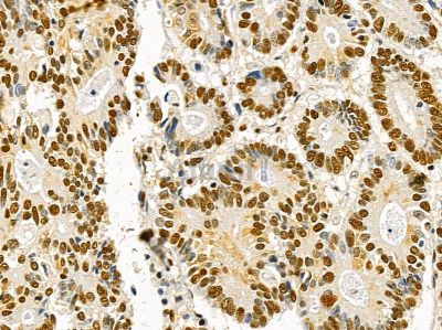 Ku70/80 Mouse Monoclonal Antibody - BF8506 at 1/100 staining human prostate cancer by IHC-P.