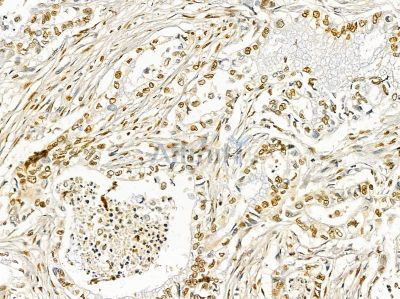 Ku70/80 Mouse Monoclonal Antibody - BF8506 at 1/100 staining human pancreatic cancer by IHC-P.