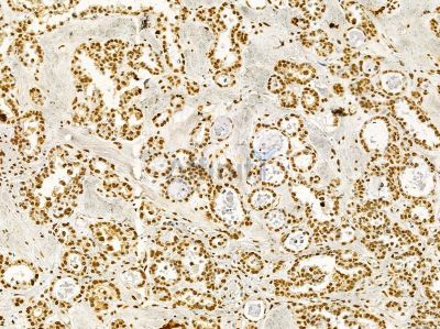 Ku70/80 Mouse Monoclonal Antibody - BF8506 at 1/100 staining human ovarian cancer by IHC-P.