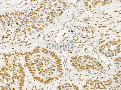 Ku70/80 Mouse Monoclonal Antibody - BF8506 at 1/100 staining human lung cancer and para-carcinoma tissue by IHC-P.