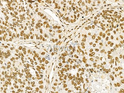Ku70/80 Mouse Monoclonal Antibody - BF8506 at 1/100 staining human lung cancer by IHC-P.