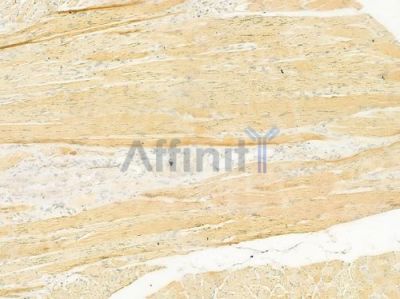 RYR2 Antibody - AF0015 at 1/100 staining human tongue carcinoma by IHC-P.