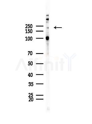 Phospho-BRCA1 (Ser1457) Antibody - Western blot analysis of lysates from EC304 cells, using Phospho-BRCA1 (Ser1457) Antibody at 1/1000 dilution.