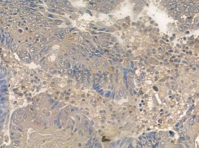 GLUT3 Antibody - AF0174 at 1/100 staining human colon carcinoma by IHC-P.