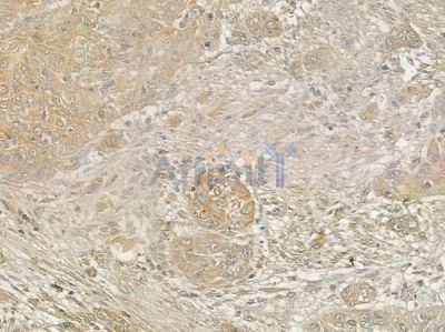 GLUT3 Antibody - AF0174 at 1/100 staining human tongue carcinoma by IHC-P.