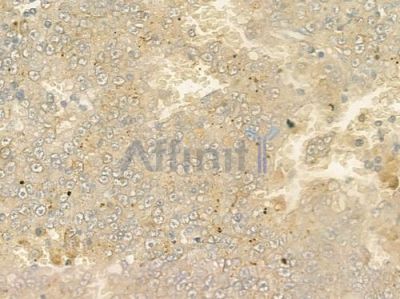 CDKN2A/p16INK4a Antibody - AF0228 at 1/100 staining human melanoma by IHC-P.