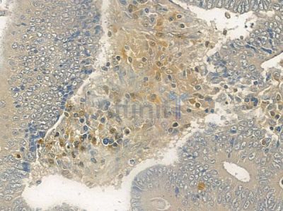 CDKA1 / DOC1 Antibody - AF0309 at 1/100 staining human colon carcinoma by IHC-P.