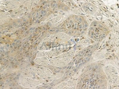 CDKA1 / DOC1 Antibody - AF0309 at 1/100 staining human esophageal carcinoma by IHC-P.