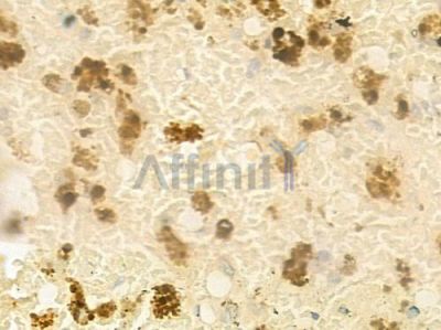 HAIR Antibody - AF0331 at 1/100 staining human melanoma by IHC-P.