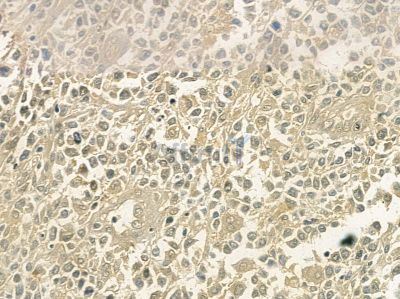Acetyl-NF-kappaB p65 (Lys310) Antibody - AF1017 at 1/100 staining human mammary cancer and adjacent non-tumor tissue by IHC-P.