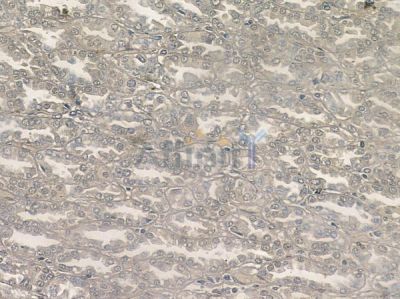 Phospho-pan-AKT1/2/3 (Tyr315/Tyr316/Tyr312) Antibody - AF1022 at 1/100 staining human renal cell carcinoma by IHC-P.